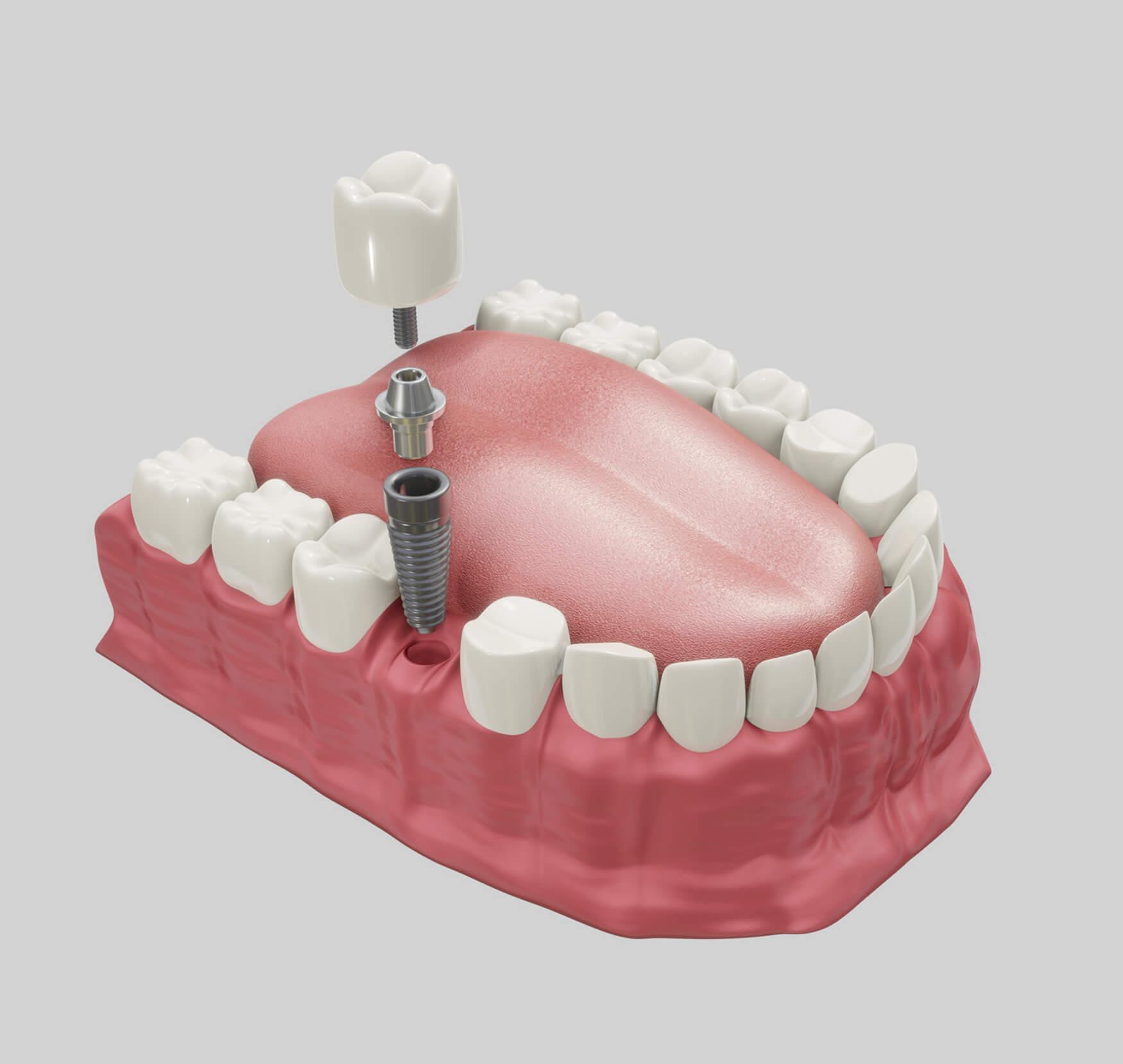 Implantology Course
